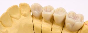diagnostic-wax-up-2_web